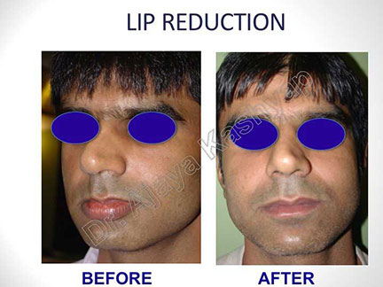 lip reduction surgery in India