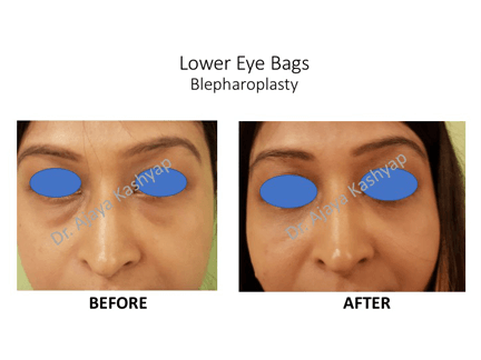 Lower Eye Bags Blepharoplasty Surgery