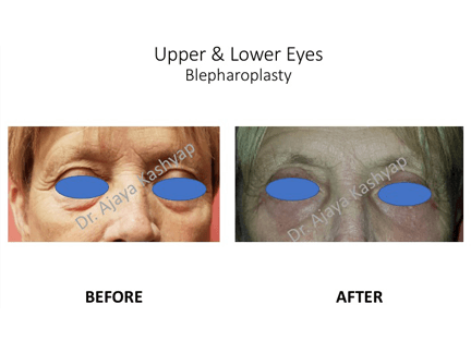 Upper & Lower Eyes Blepharoplasty