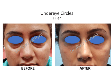 Undereye Circles Filler