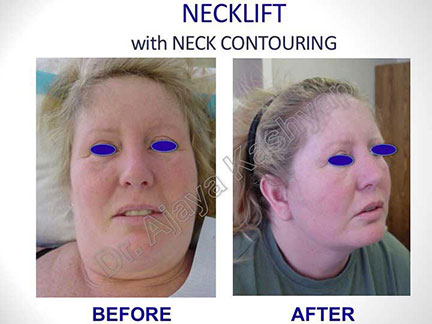 neck lift cost in India