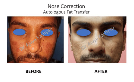 nose surgery in India