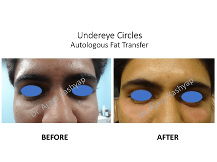 Undereye Circles Autologous Fat Transfer