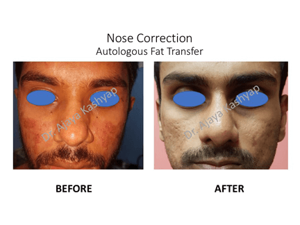 Nose Correction Autologous Fat Transfer
