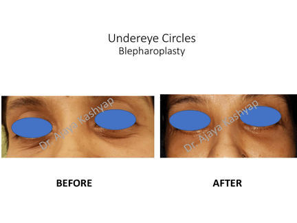 Undereye Circles Blepharoplasty