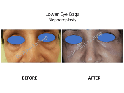 Lower Eye Bags Blepharoplasty