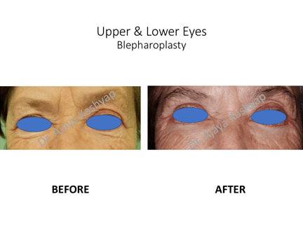 Upper & Lower Eyes Blepharoplasty Surgery