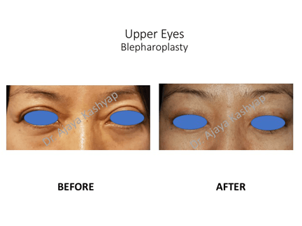 Upper Eyes Blepharoplasty