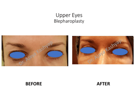 Upper Eyes Blepharoplasty Surgery