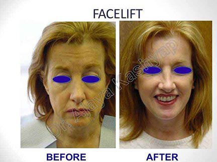 facelift surgery in India