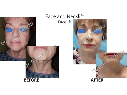 Face and Neck Lift