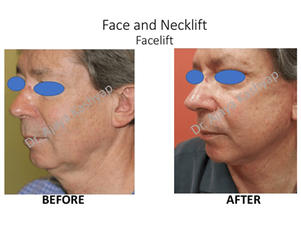 Face and Neck Lift Surgery