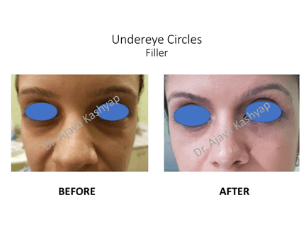 Undereye Circles Filler Treatment