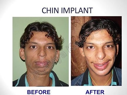 chin implants surgery in India