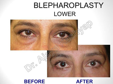 blepharoplasty surgery in India