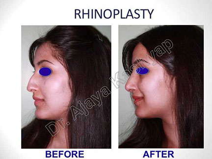 rhinoplasty surgery in India