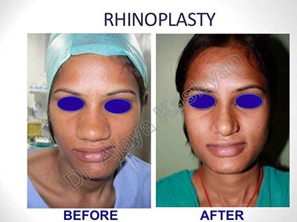 nose surgery in India