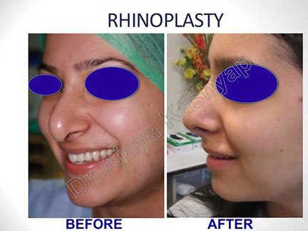 rhinoplasty cost in India