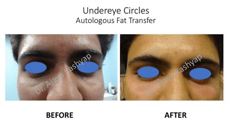 under eye treatment in Delhi