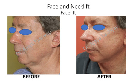 face lift surgery in India