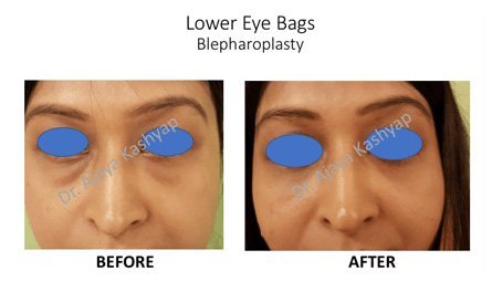 eyelid surgery in Delhi