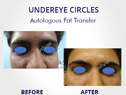 under eye circle treatment in delhi