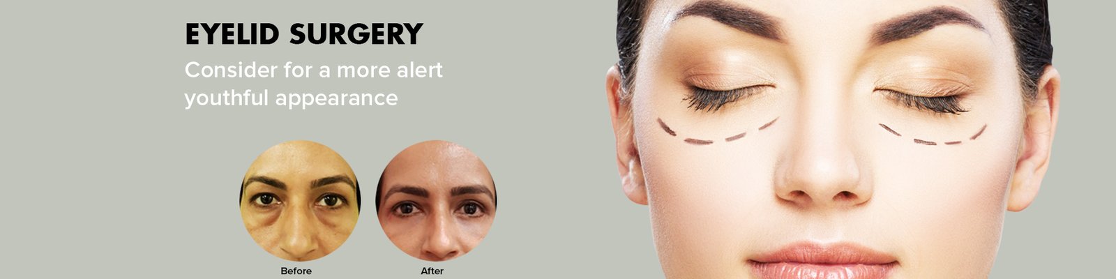 eyelid surgery in gurugram