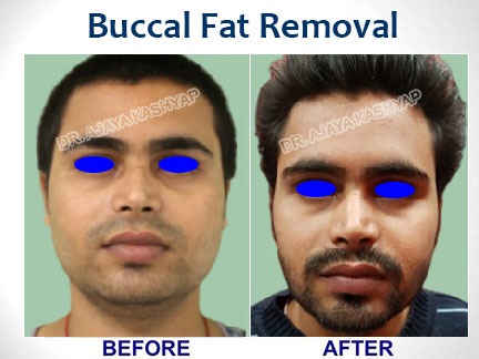 buccal fat removal