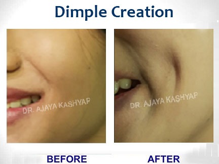 dimple creation