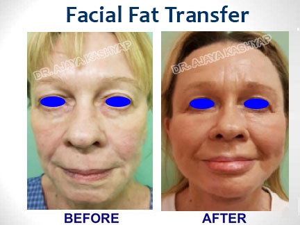 facial fat transfer