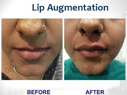 lip augmentation